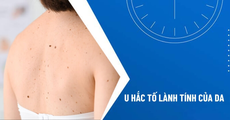 u hắc tố lành tính của da