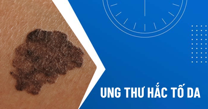 ung thư hắc tố da