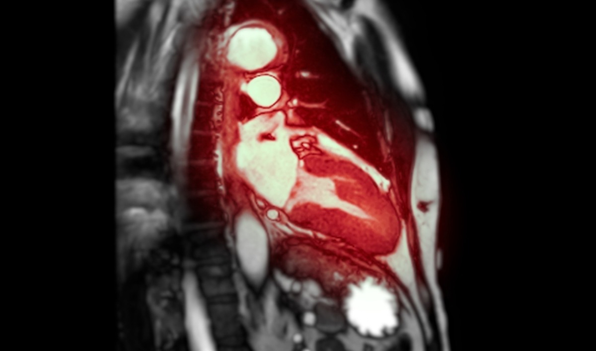 chụp xạ hình tưới máu cơ tim gắng sức