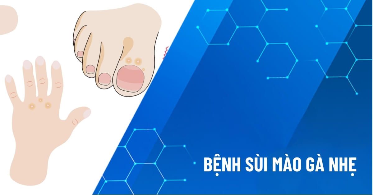 bệnh sùi mào gà nhẹ