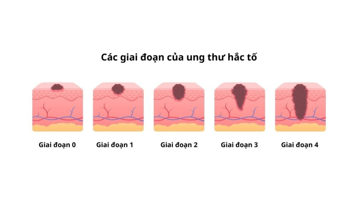các giai đoạn của ung thư hắc tố da