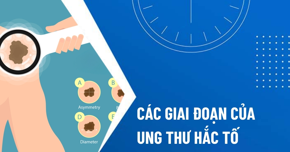 các giai đoạn của ung thư hắc tố