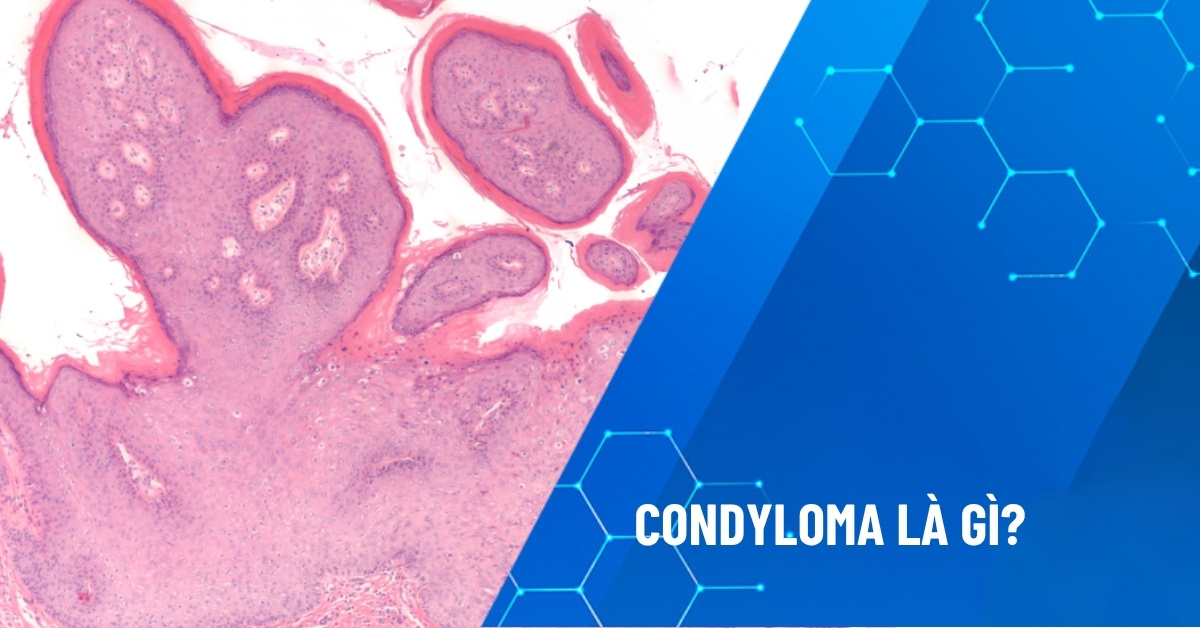 condyloma