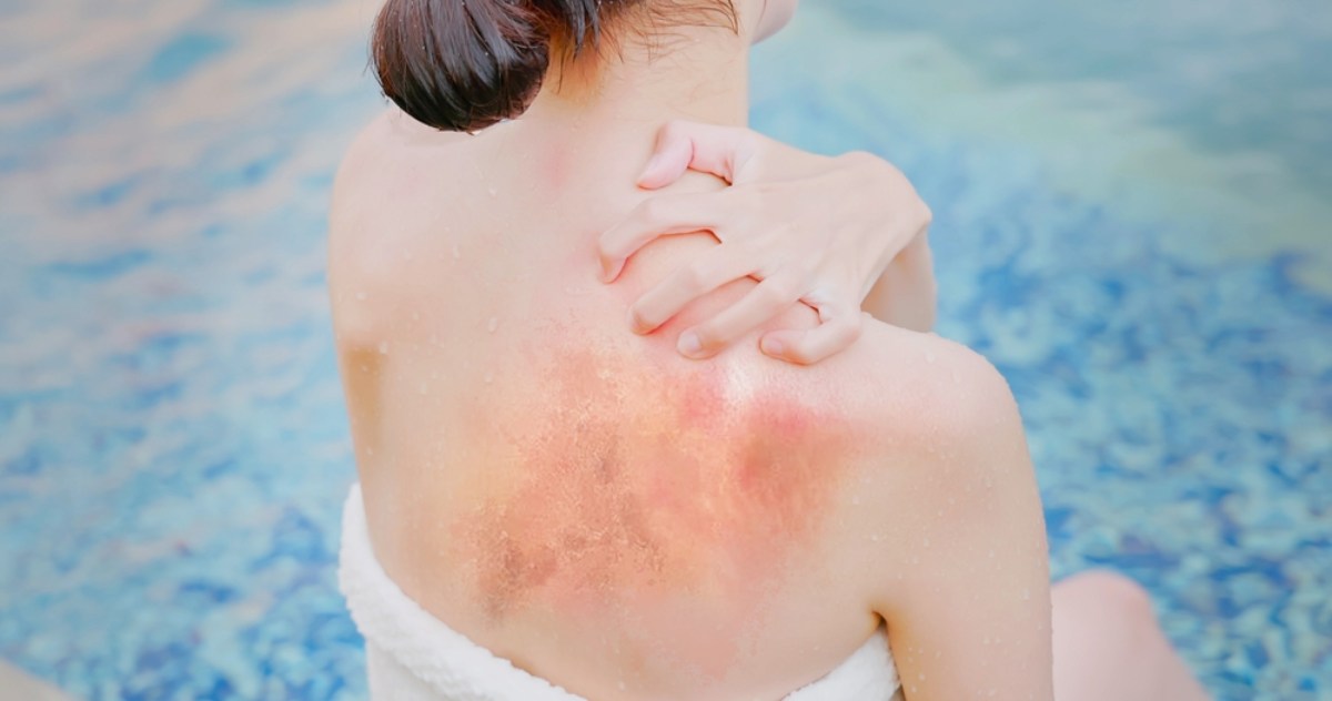 da bị dị ứng nước hồ