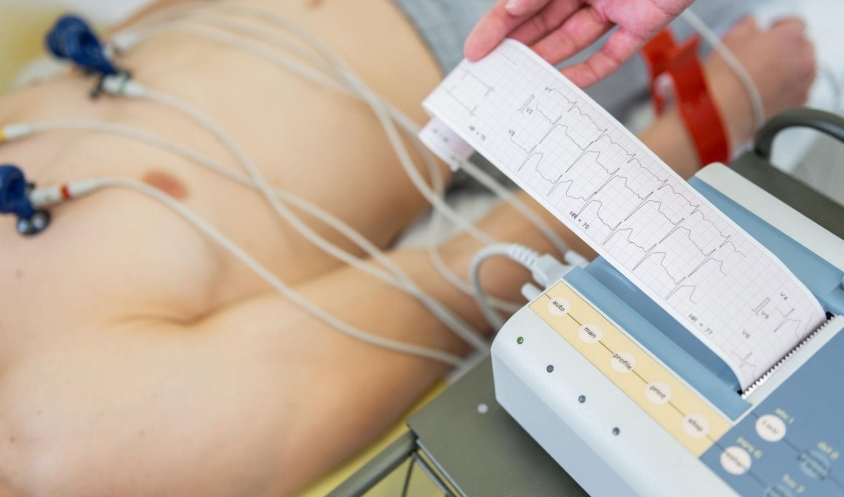 đo điện tâm đồ chuẩn đoán viêm cơ tim