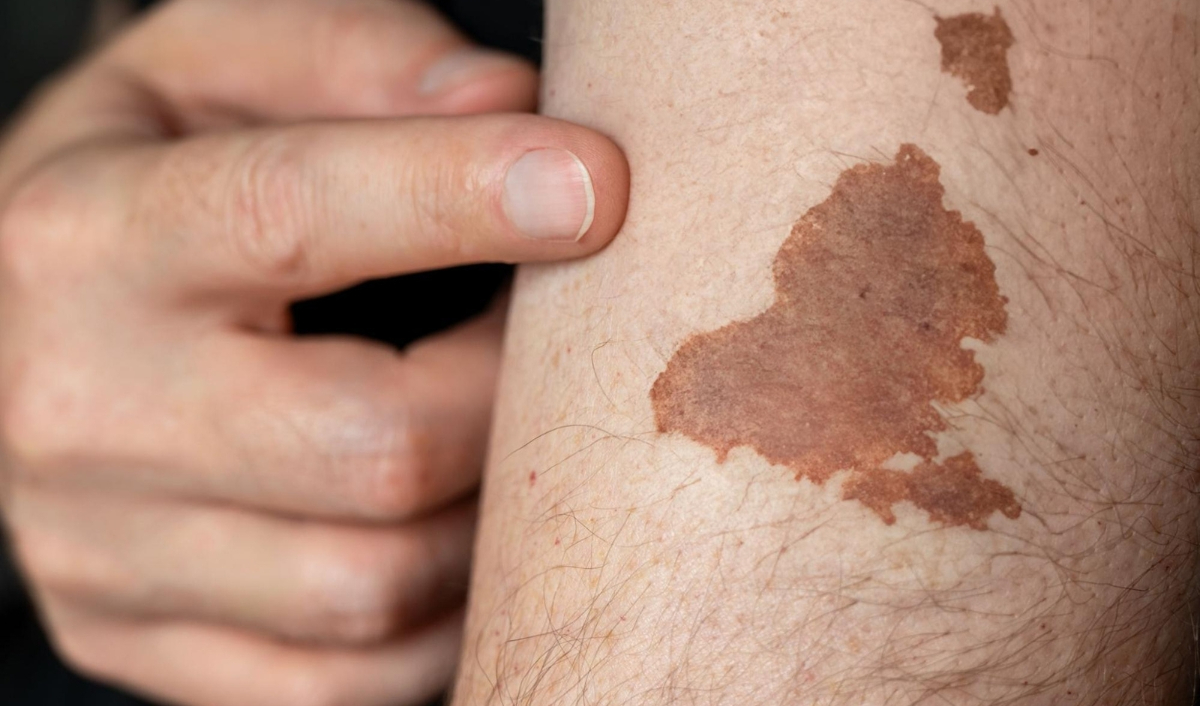 ảnh nốt ruồi u hắc tố trên da