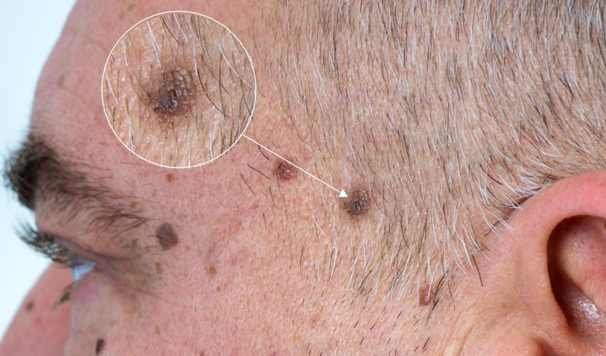 hình ảnh nốt ruồi ung thư hắc tố da ở trên đầu