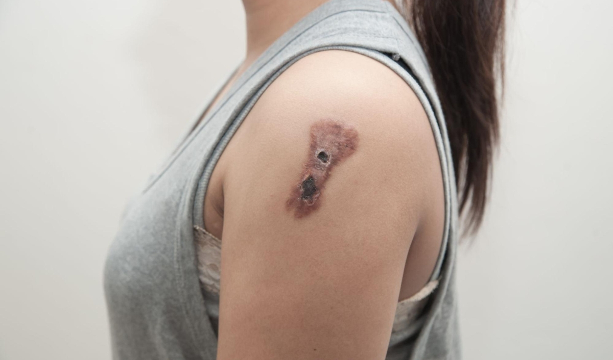 nốt ruồi ung thư sắc tố da ở cánh tay