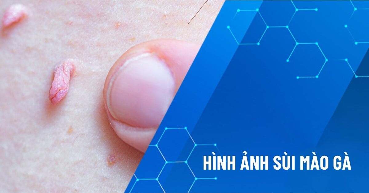 hình ảnh sùi mào gà