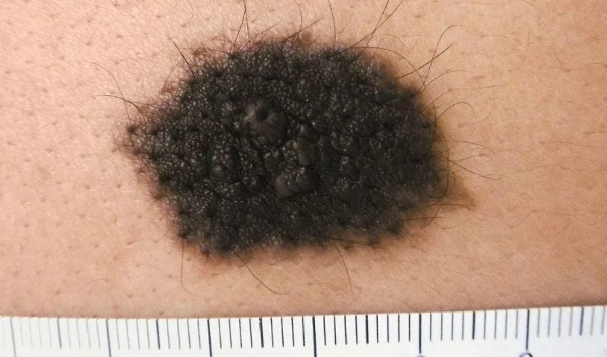 kích thước khối u hắc tố bẩm sinh