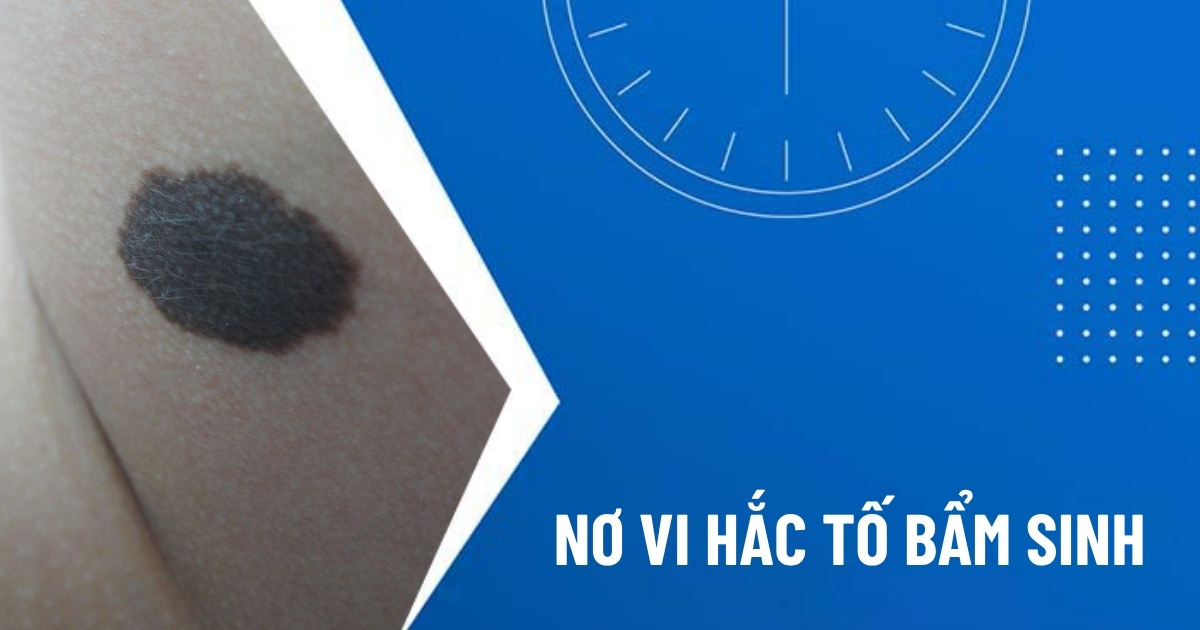 nơ vi hắc tố bẩm sinh