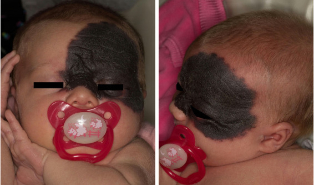 nơ hắc hắc tố mảng rộng ở mặt trẻ nhỏ