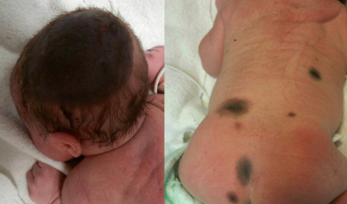 nơ vi sắc tố ở lưng và mông trẻ