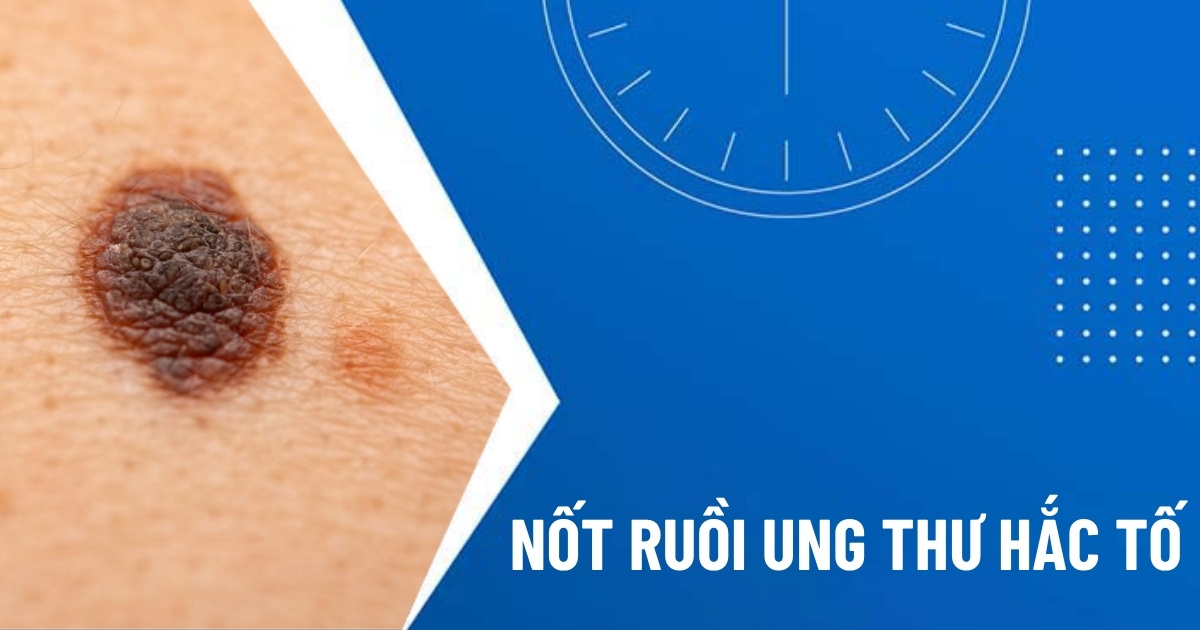 nốt ruồi ung thư hắc tố da