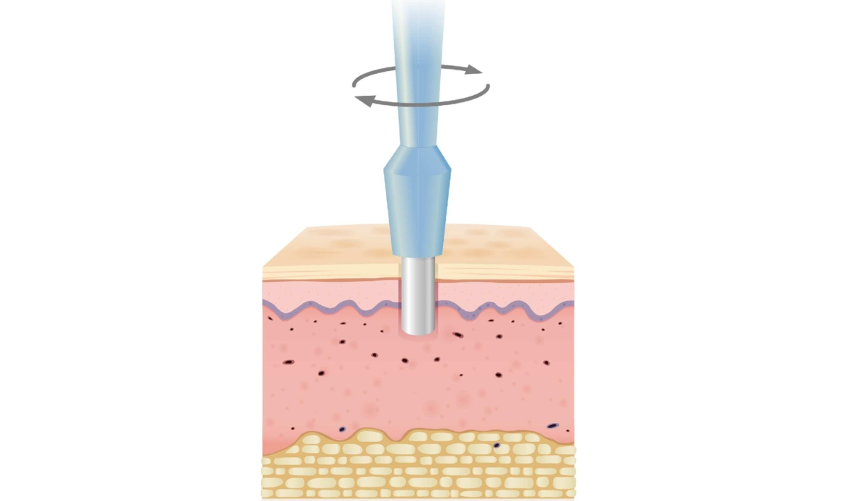 sinh thiết da phát hiện nơ vi hắc tố