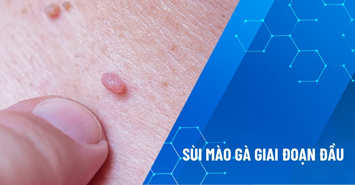 sùi mào gà giai đoạn đầu
