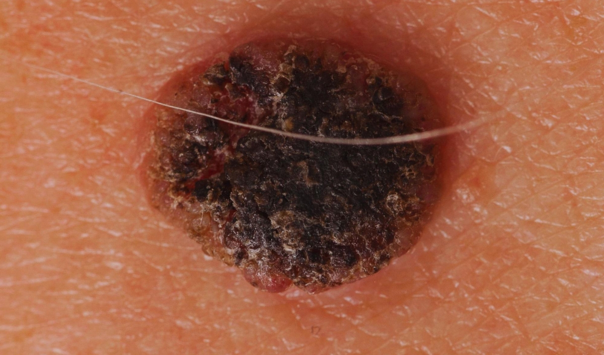 cắt bỏ tổn thương ung thư hắc tố giai đoạn cuối