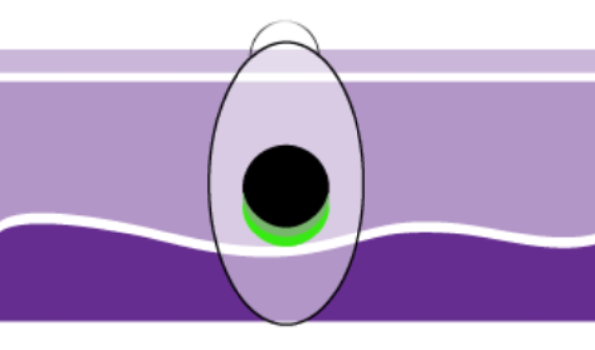 u hắc tố giai đoạn 2b