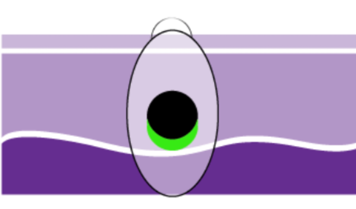 u hắc tố giai đoạn 2c