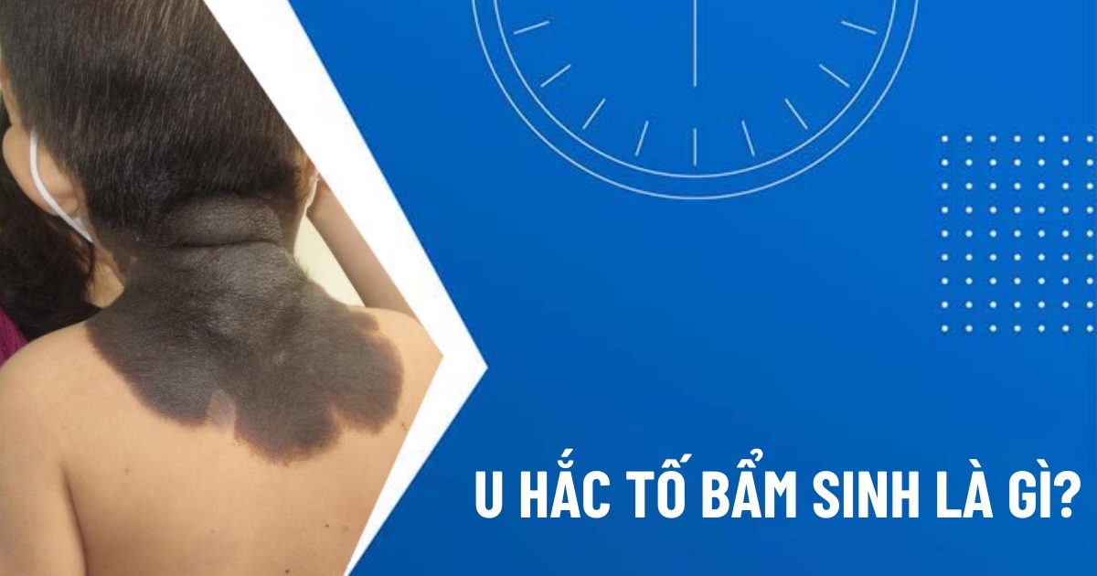 u sắc tố bẩm sinh