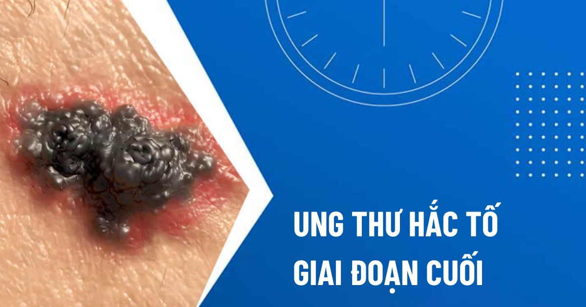 ung thư hắc tố da giai đoạn cuối