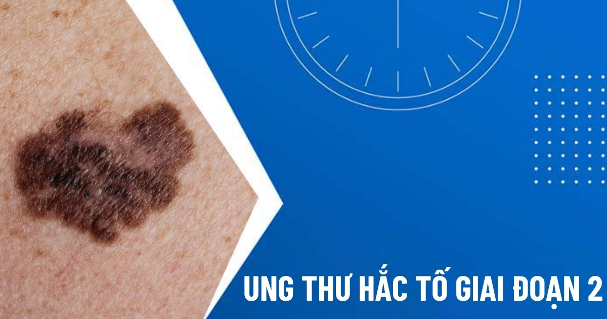 ung thư hắc tố giai đoạn 2