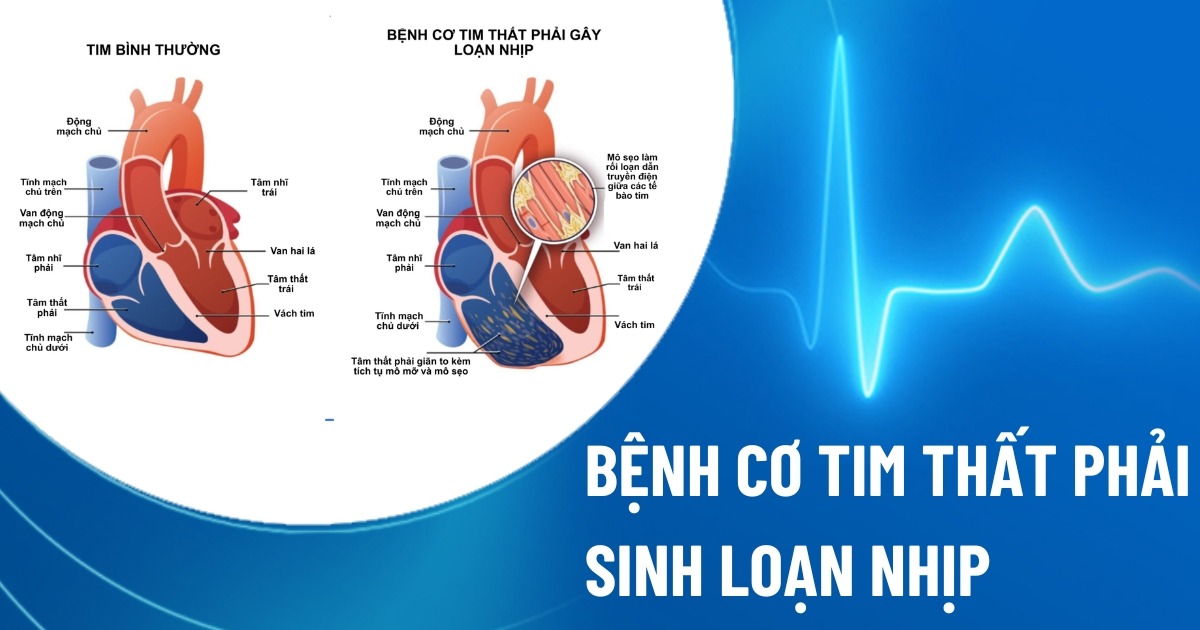 bệnh cơ tim thất phải gây loạn nhịp