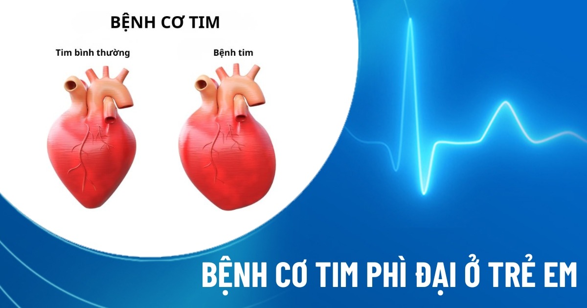 cơ tim phì đại ở trẻ em
