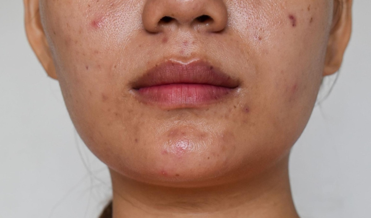 đốm tăng sắc tố rải rác trên mặt