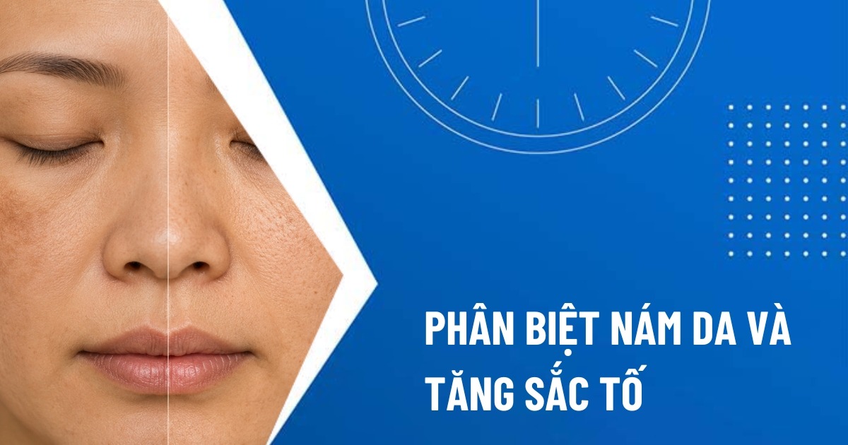 nám và tăng sắc tố
