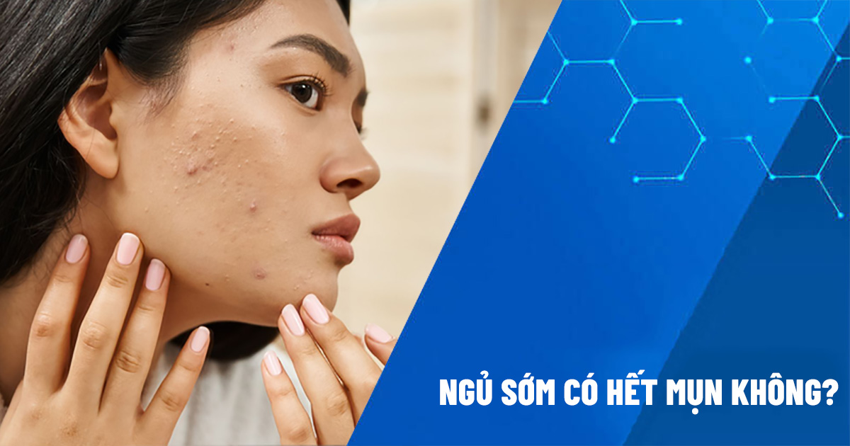 Ngủ sớm có hết mụn không? Mối liên hệ giữa ngủ sớm và mụn trứng cá?