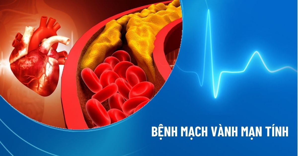 bệnh mạch vành mạn tính