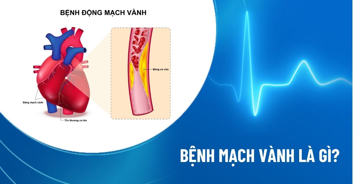 bệnh mạch vành