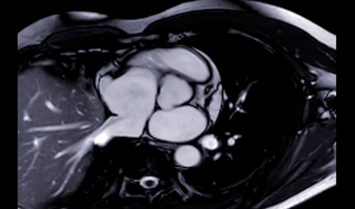 chụp mri thấy vết sẹo trên cơ tim