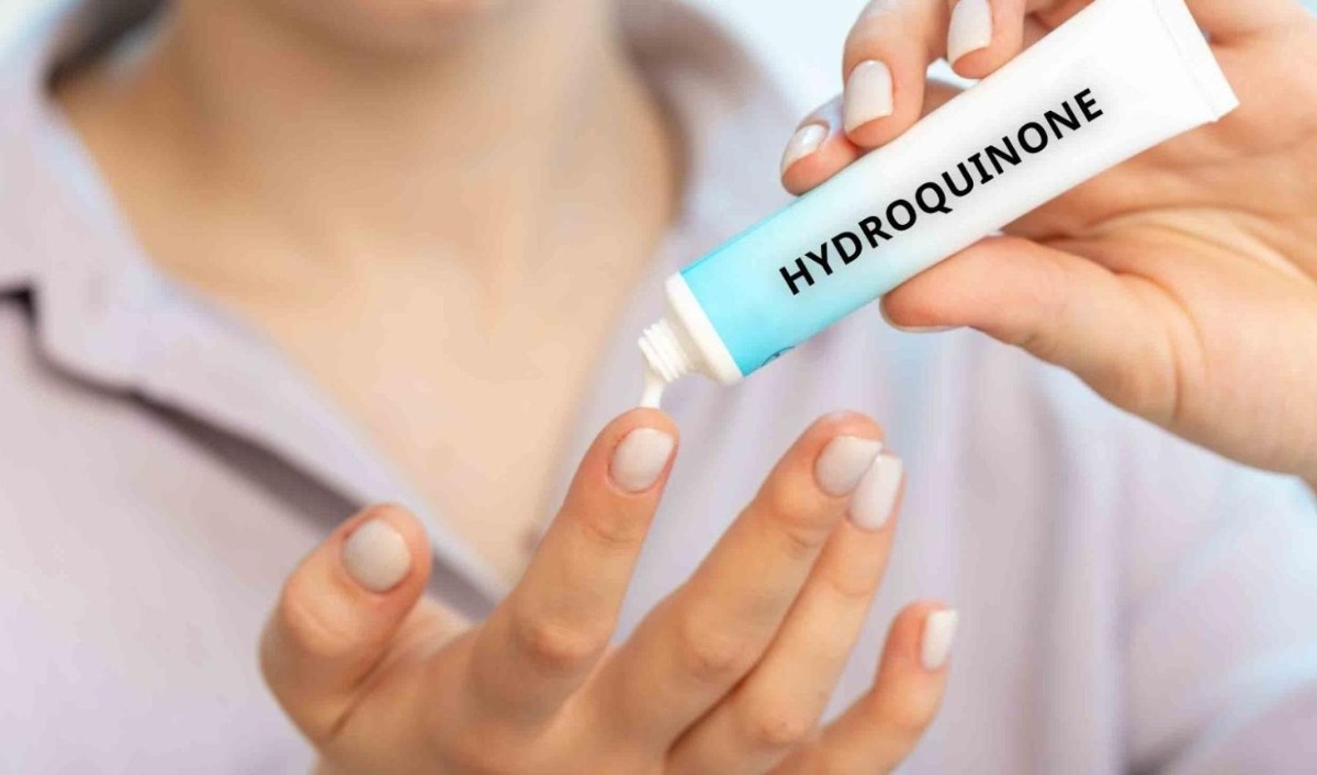 bôi hydroquinone trị nám nội tiết