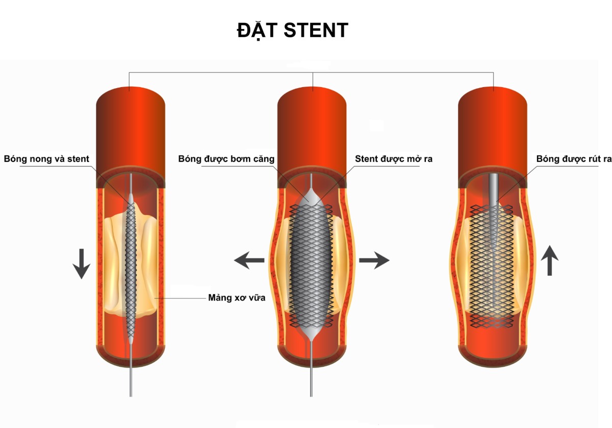 quy trình đặt stent bệnh nhân mạch vành