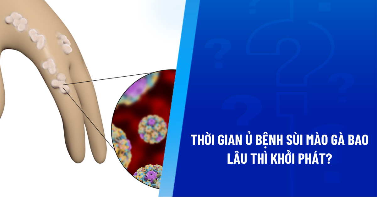 thời gian ủ bệnh sùi mào gà