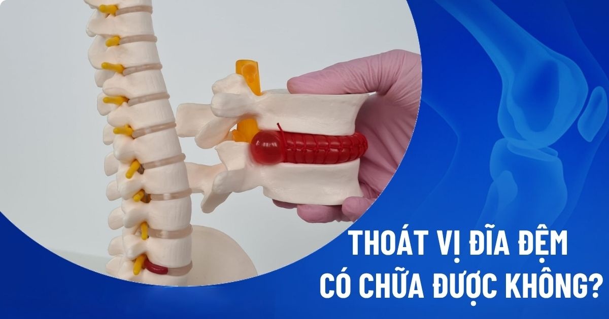 Bệnh thoát vị đĩa đệm có chữa được không​