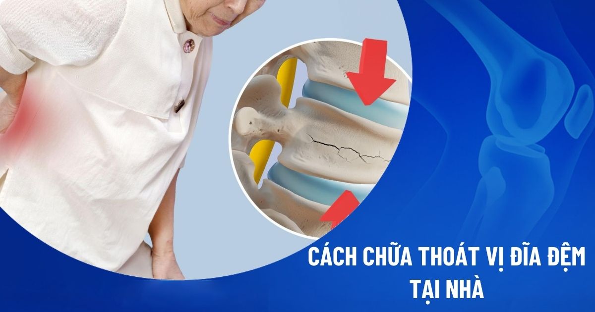 Cách chữa thoát vị đĩa đệm tại nhà​