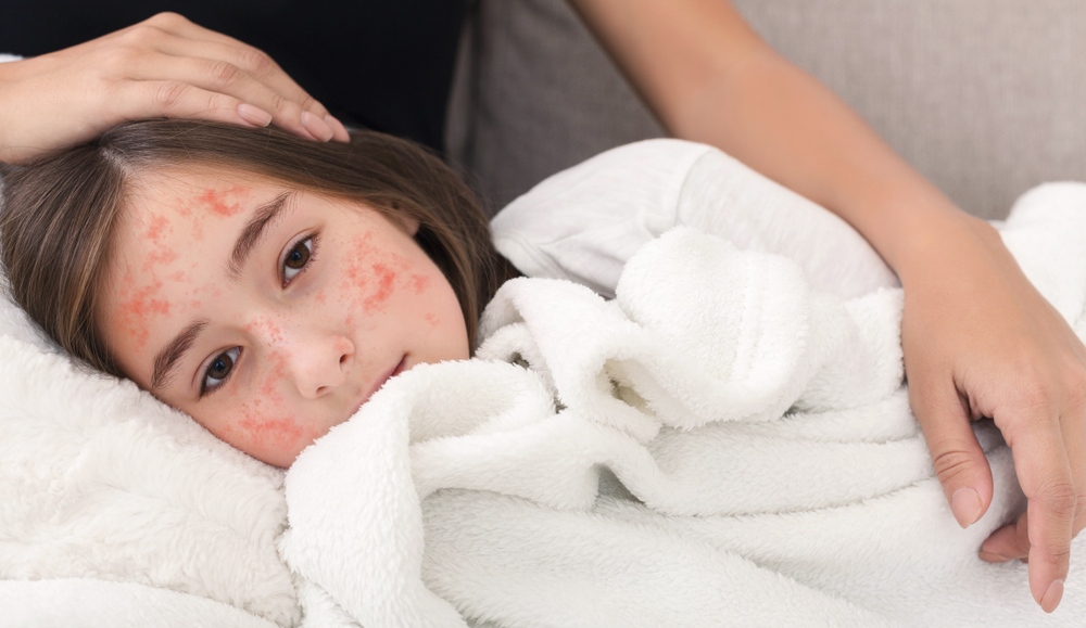 bé gái bị bệnh thủy đậu