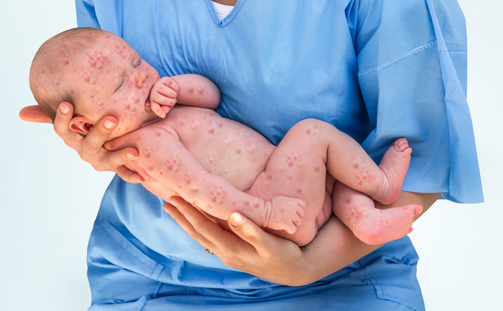 bé sơ sinh mắc thủy đậu