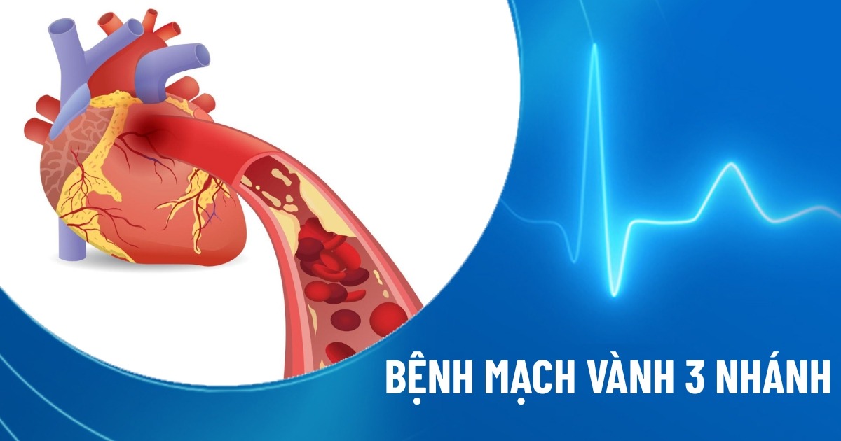 bệnh mạch vành 3 nhánh