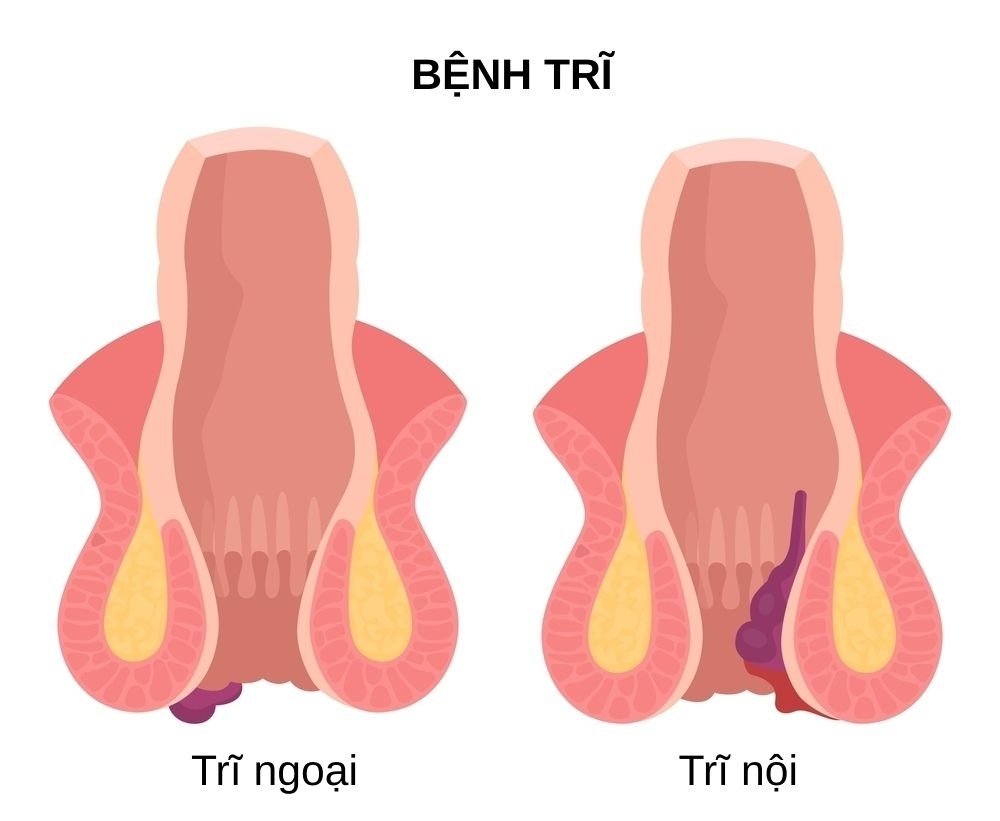bệnh trĩ nội ngoại