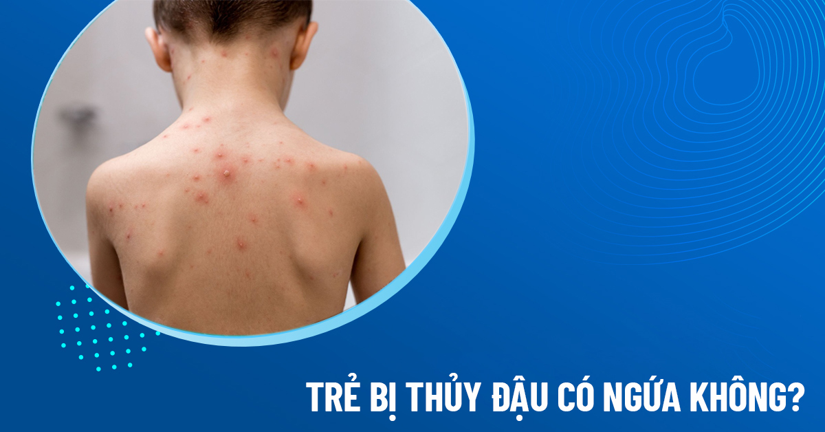 bị thủy đậu có ngứa không