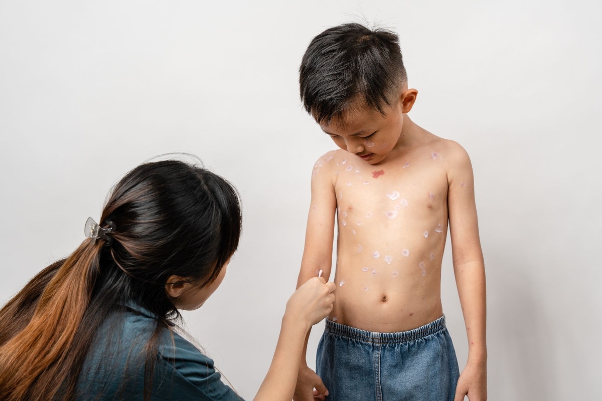bôi kem thủy đậu