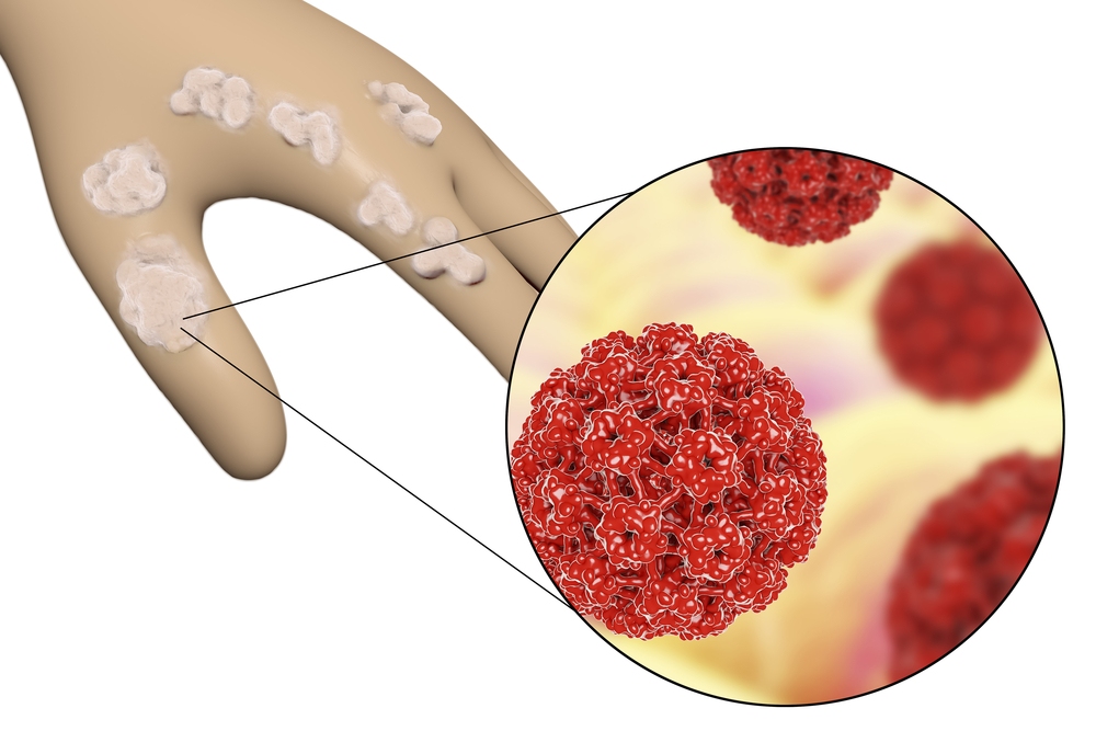 các virus hpv lây lan ở tay