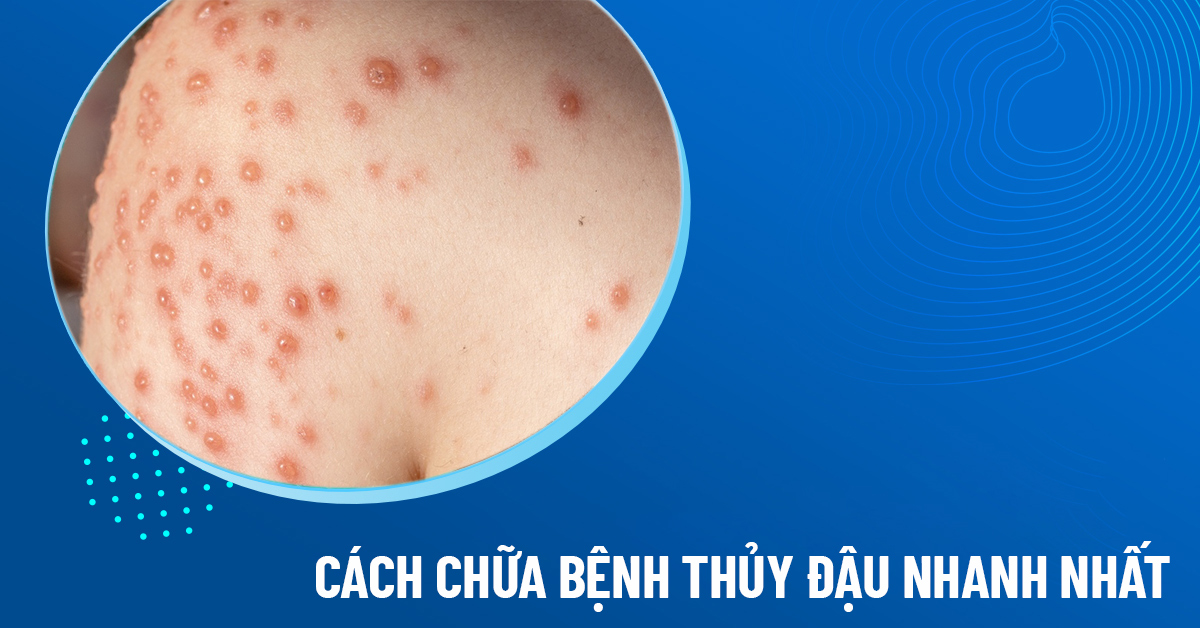 cách chữa thủy đậu
