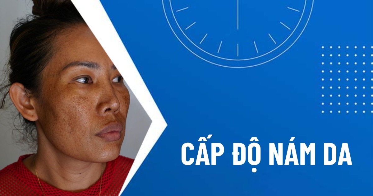 cấp độ nám da