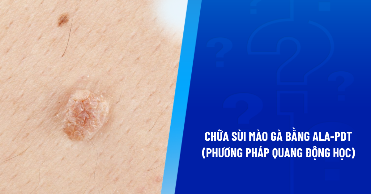 chữa sùi mào gà bằng lal-pdt