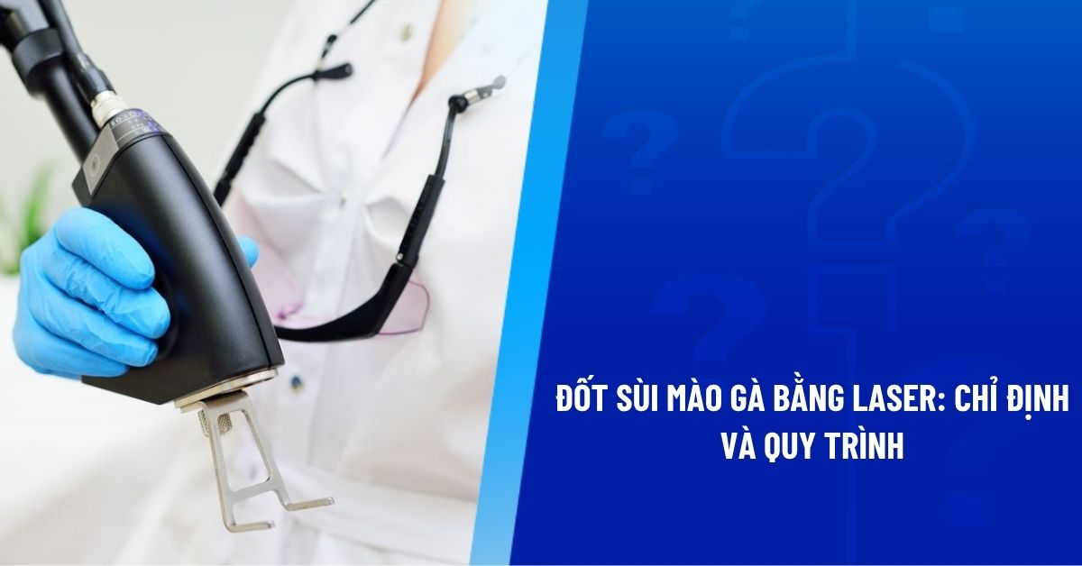 đốt sùi mào gà bằng laser
